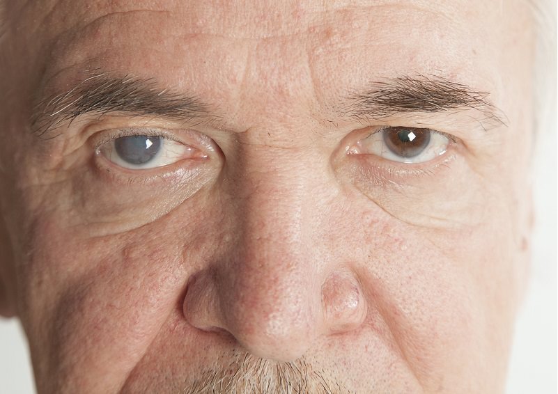 anciano con degeneración macular