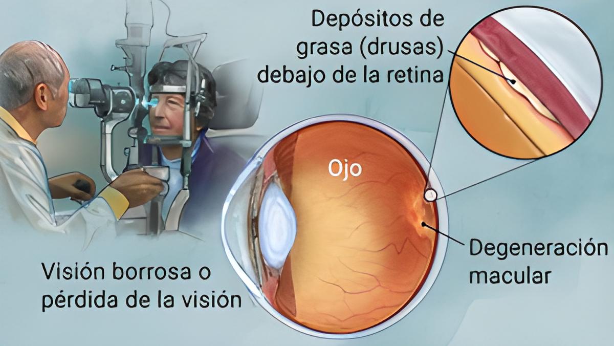 La Degeneración macular se puede tratar con vabysmo